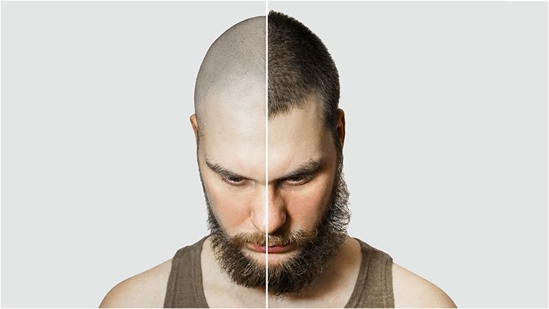 Человек до и после выпадения волос, пересадка на фоне