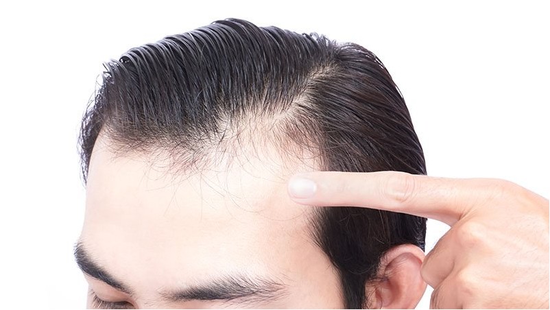 Молодой человек серьезная проблема выпадения волос для здравоохранения медицинских и